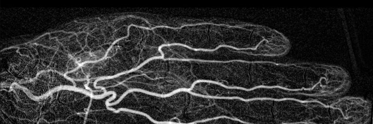 Leistung Angiographie öffnen