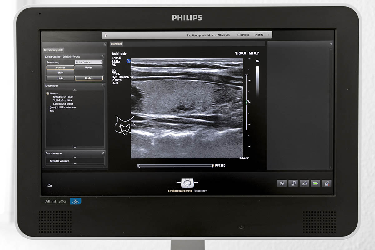 Ultraschallbild der Schilddrüse, das auf einem medizinischen Monitor angezeigt wird und die Gewebestrukturen im Querschnitt sowie Messdetails zeigt.