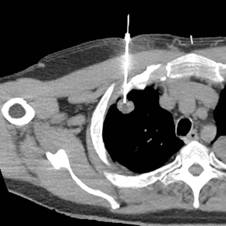 Leistung CT-gesteuerte Punktion öffnen