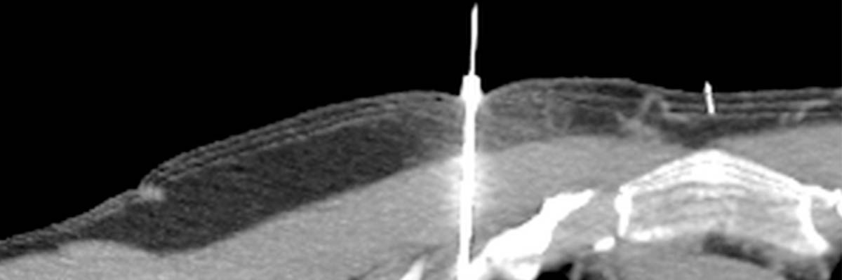 Die CT-Aufnahme des oberen Brustkorbs zeigt eine Nadel, die in den linken Lungenbereich eingeführt wurde.